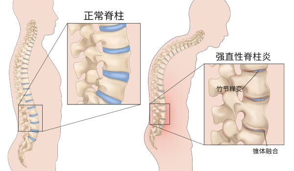 『附一科普』腰背部疼痛一定是腰椎间盘突出吗？这种情况需警惕