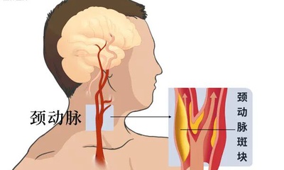 『附一医讯』国际前沿手术落地！福医附一医院血管外科成功完成三例逆血流保护装置下经颈动脉支架成形术（TCAR）