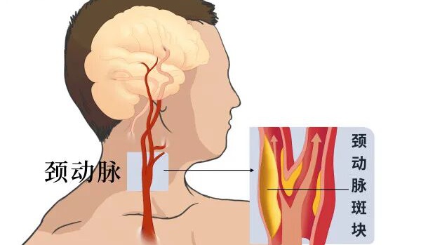 『附一医讯』国际前沿手术落地！福医附一医院血管外科成功完成三例逆血流保护装置下经颈动脉支架成形术（TCAR）