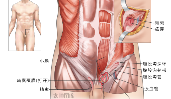 『附一科普』大腿根鼓个包？别慌！腹股沟疝这样应对