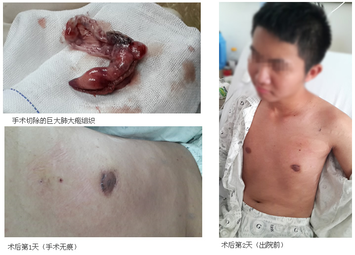 我院胸外科成功开展胸腔无痕手术治疗气胸