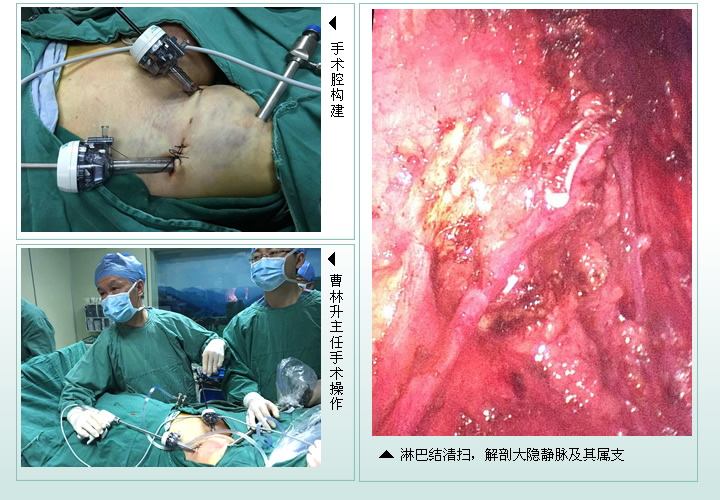 泌尿外科二区成功开展我院首例腹腔镜下阴茎癌双侧腹股沟淋巴结清扫术 泌尿外科二区成功开展我院首例腹腔镜下阴茎癌双侧腹股沟淋巴结清扫术