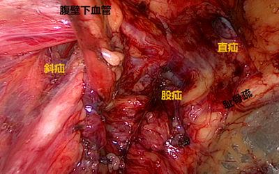 腹腔镜疝修补术优势多:钻3孔补6洞 腹腔镜疝修补术优势多:钻3孔补6洞