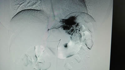 我院介入科开展肝血管瘤的微创介入治疗