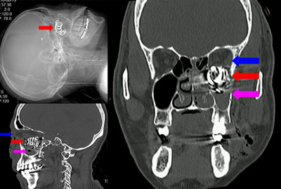 一声枪响弹簧扎入面中  两科协作异物取离眶鼻
