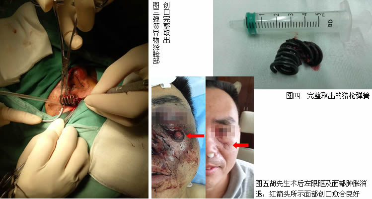 一声枪响弹簧扎入面中  两科协作异物取离眶鼻