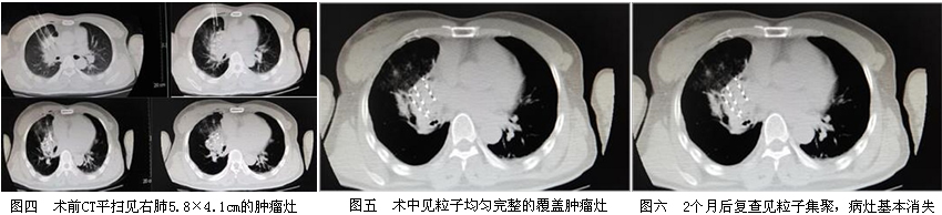我院介入科成熟应用放射性粒子植入术为肺癌患者带来新曙光