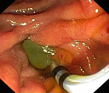 不负台胞信任——我院肝胆胰外科为其成功施行无X线下ERCP术