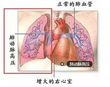 『媒体看附一』肺动脉高压 易隐形易误诊得留神