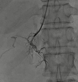 我院成功开展肾上腺静脉采血为实现高血压精准医疗迈出坚实一步