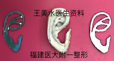 福建医大附一医院整形外科王美水主任医师在韩国大邱加图立大学医学中心(DCUMC)成功开展该院首例小耳症Nagata法耳再造手术