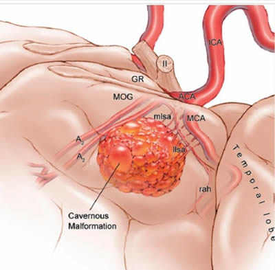 穿越“束”缚　精准“窃”除——我院神经外科应用功能神经导航辅助下Endoport内镜新技术为患者成功切除脑深部海绵状血管瘤