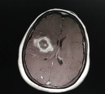 穿越“束”缚　精准“窃”除——我院神经外科应用功能神经导航辅助下Endoport内镜新技术为患者成功切除脑深部海绵状血管瘤