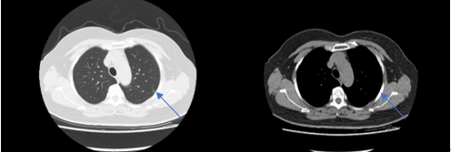 免插管免禁食!我院胸外科肺结节切除手术进入微创新时代 免插管免禁食!我院胸外科肺结节切除手术进入微创新时代